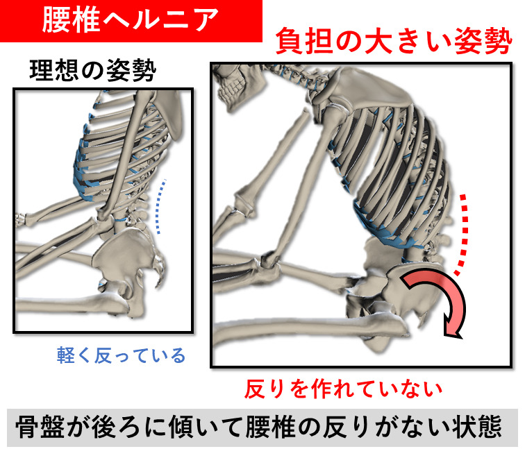 腰椎ヘルニアの負担の大きい姿勢のイラスト。骨盤が後ろに傾い腰椎の反りが無い状態
