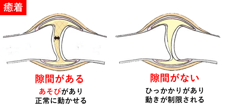 骨と骨の間に隙間がある場合は、あそびがあり正常に動かせる、骨と骨の間に隙間がない場合はひっかかりがあり動きに制限があることを表現したイラスト