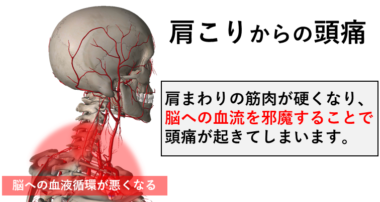 肩こりからの頭痛。肩まわりの筋肉が硬くなり、脳への血流を邪魔することで頭痛が起きてしまいます。脳への血流が悪くなるイラスト