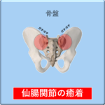 骨盤のイラストで仙腸関節の部分がガチガチ