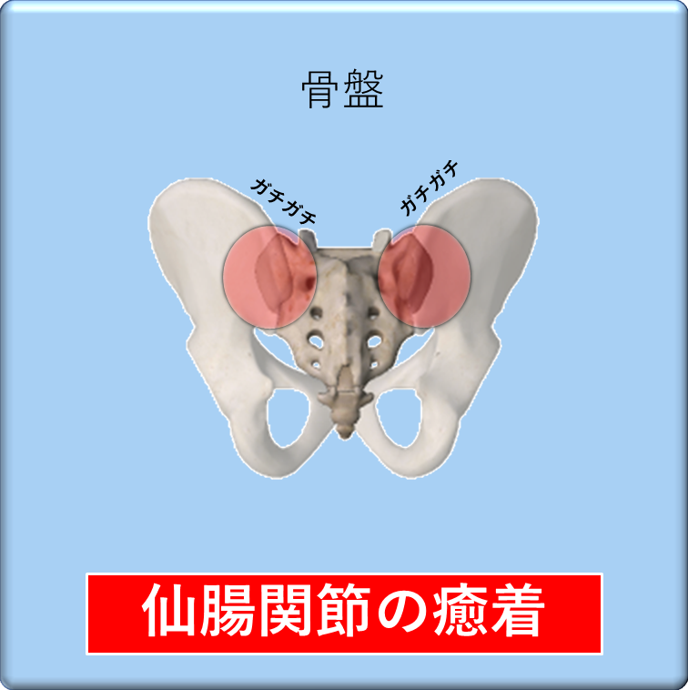 骨盤のイラストで仙腸関節の部分がガチガチ