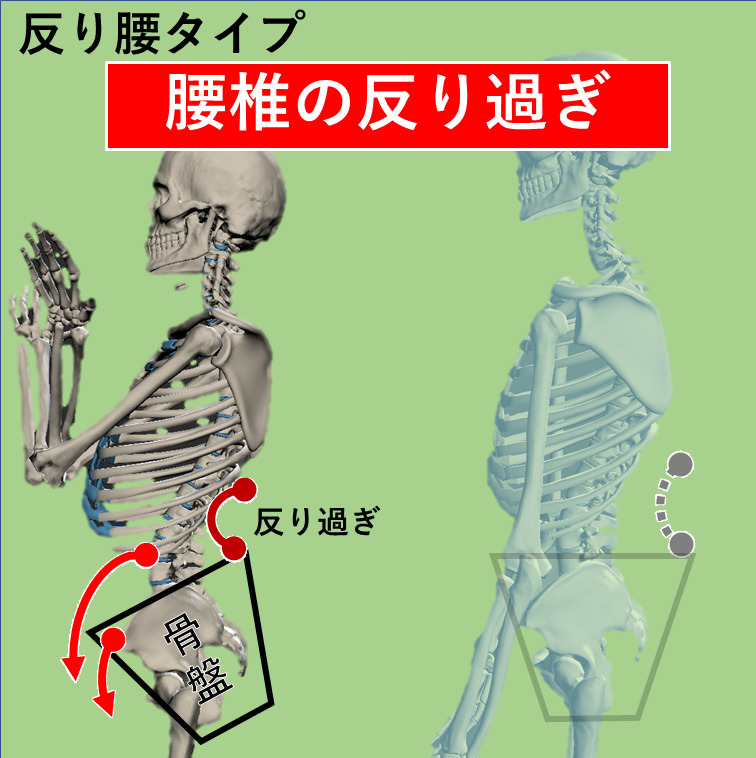 反り腰タイプの姿勢で骨盤が前に傾き、腰椎が反り過ぎているイラスト。